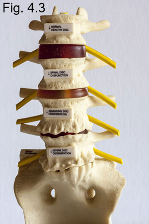 disc conditions of the spine