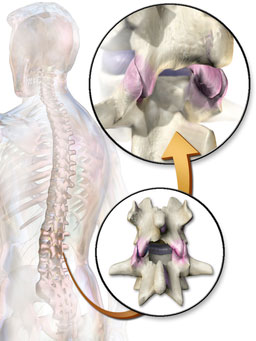 facet joints and back pain