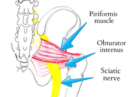 piriformis muscle pain from tightness. Obturator internus and sciatic nerve.