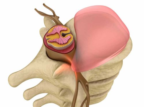 radicular pain caused by a herniated and bulging disc