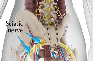 Sciatica is a very common type of radicular pain