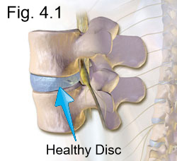 normal healthy disc