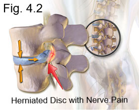 herniated disc