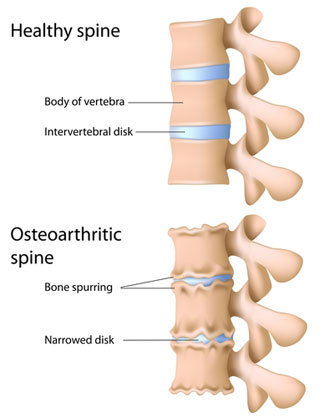 osteophyte formation and degenerative disc disease