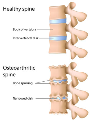 l5 s1 disc degeneration symptoms