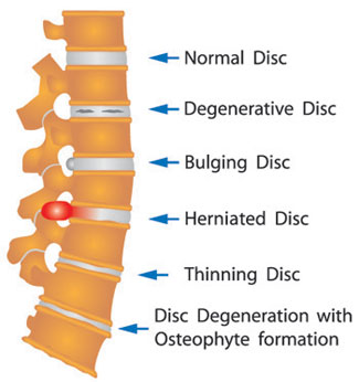 degenerative disc disease and lower back pain