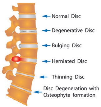 l5 s1 disc degeneration symptoms